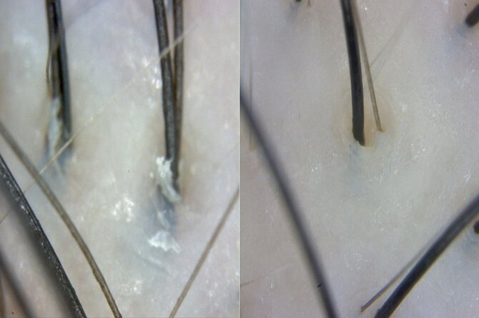 15 Step Stem Cell Scalp Treatment in Seoul - What the 90-minute session is really about